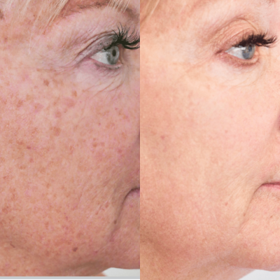 Halo Skin Resurfacing