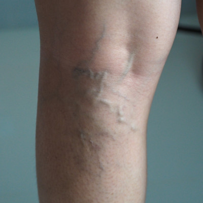 Varicose Veins