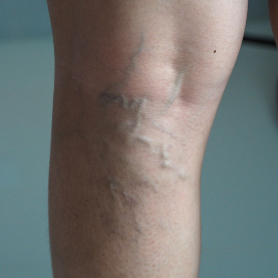 Varicose Veins