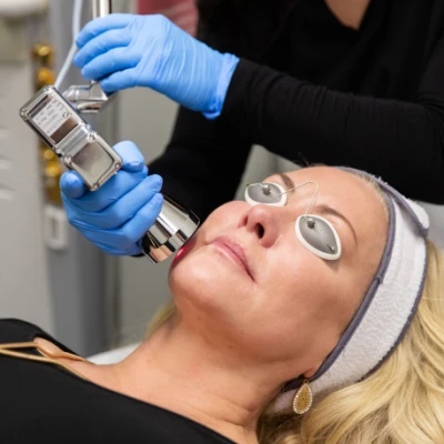 MicroLaserPeel