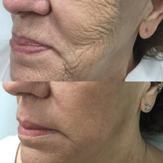 Total Resurfacing Laser