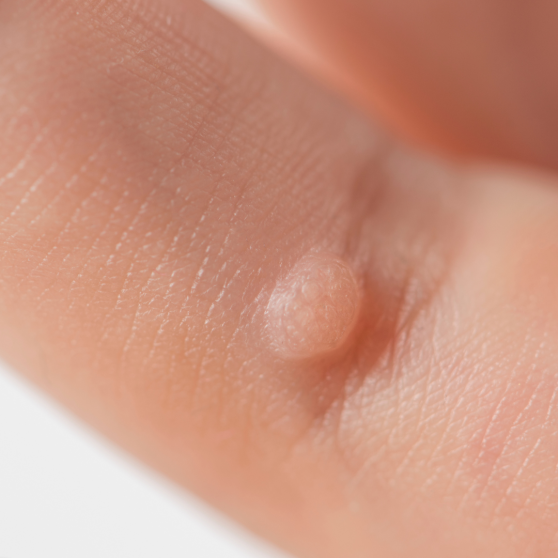 Wart Removal