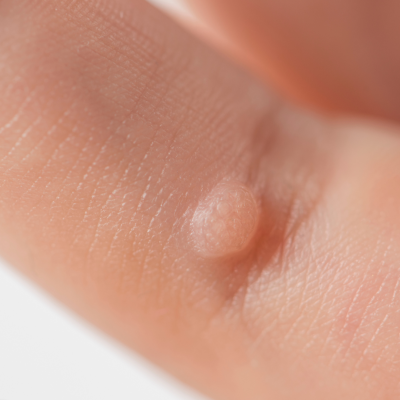 Wart Removal
