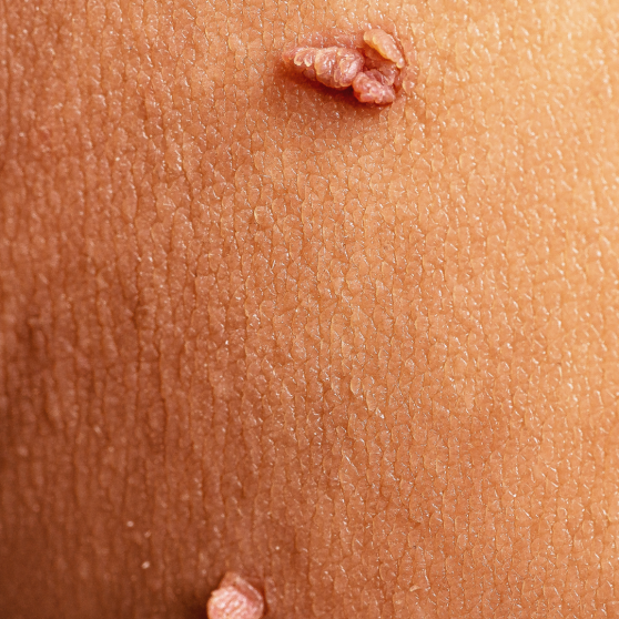 Skin Tag Removal